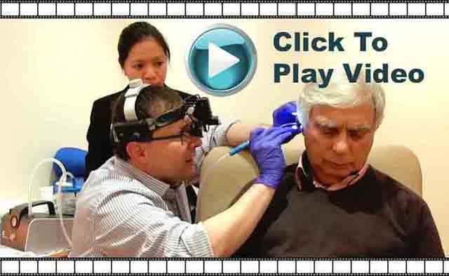 video of microsuction ear wax removal cambridge